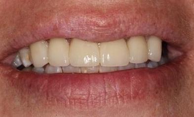 Cosmetic-Crowns-Patient-2-After-Image