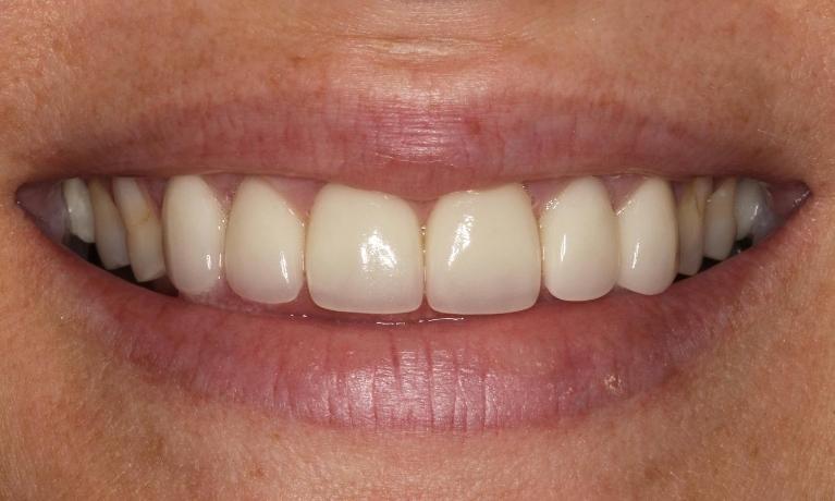 Cosmetic-Crowns-After-Image