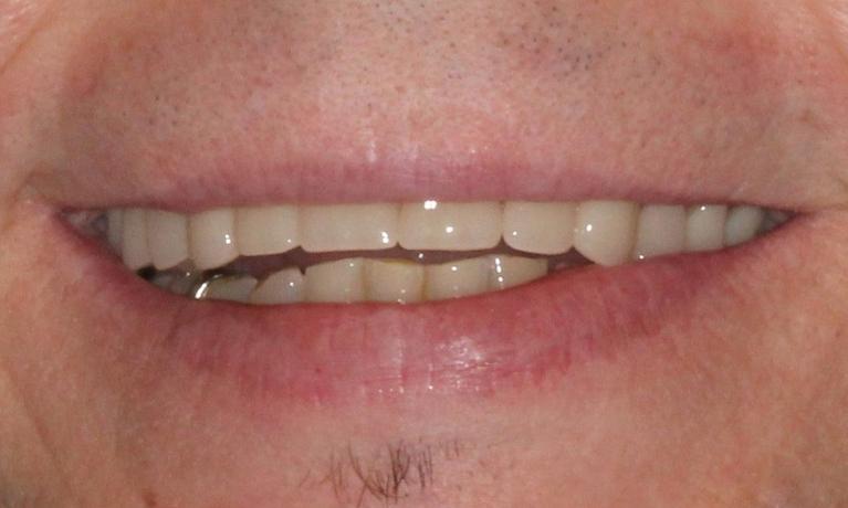 Denture-Partial-After-Image