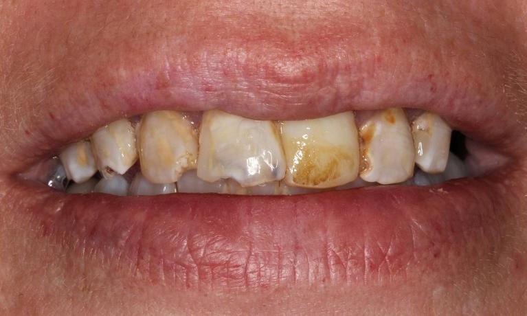 Cosmetic-Crowns-Patient-2-Before-Image
