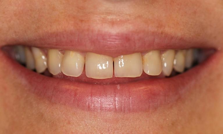 Cosmetic-Crowns-Before-Image