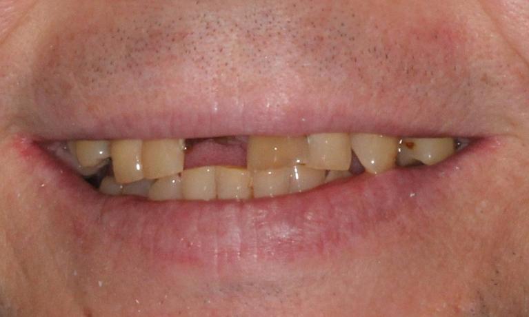 Denture-Partial-Before-Image